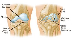 Οστεοαρθρίτιδα στο γόνατο