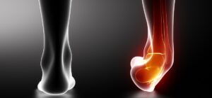 Sprained ankle black x-ray