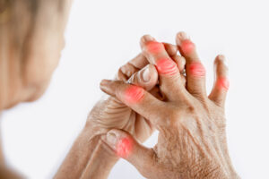 Δάχτυλα χεριού με αρθρίτιδα