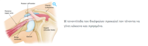 Σχεδιάγραμμα με την τενοντίτιδα δικέφαλου ώμου