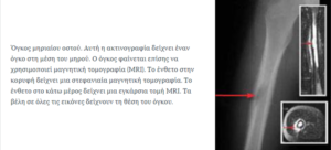 Ακτινογραφία με όγκο μηριαίου οστού