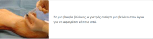 Βιοψία βελόνας οστού με όγκο