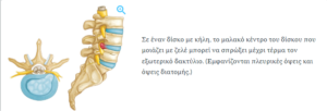 Δισκοκήλη στην σπονδυλική στήλη